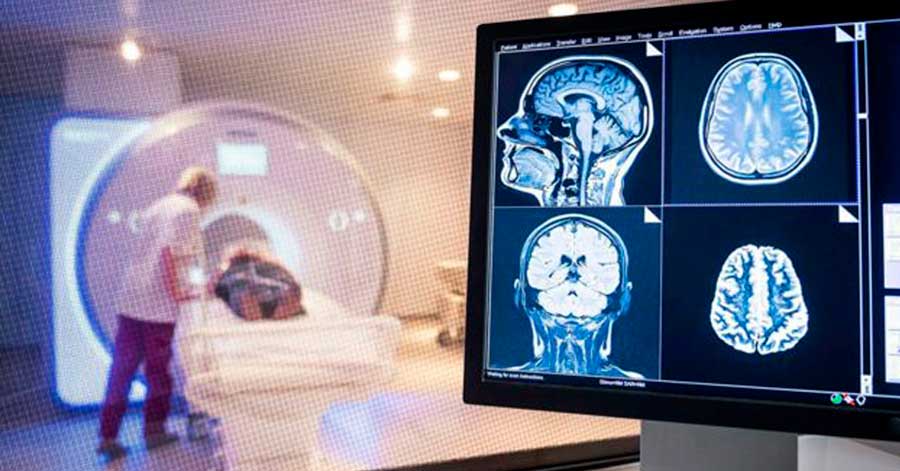 Coronavirus: los médicos que advierten de los efectos que el covid-19 puede tener en el cerebro