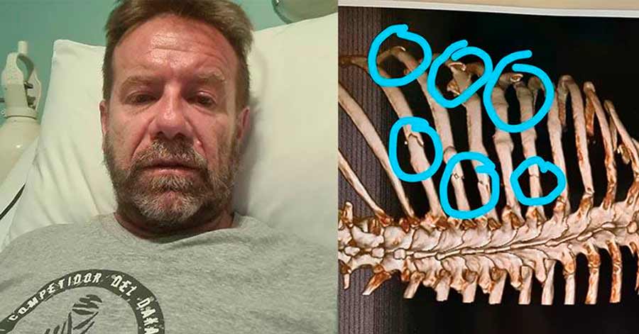 Walter Nosiglia Navarro sufre fractura de siete costillas tras caída en entrenamiento